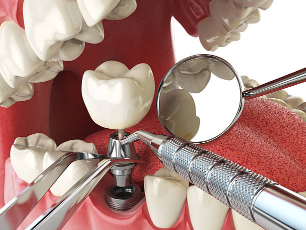 Best Cracked Tooth Emergency Dentist  in Owensville, MO